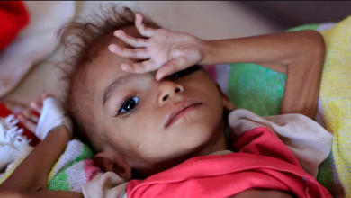 Photo of سوء التغذية في اليمن.. شبح جديد يهدد حياة الأطفال