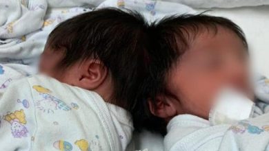 Photo of العملية الأولى من نوعها في البلاد: فصل توأمتين ولدتا برأسين ملتصقين