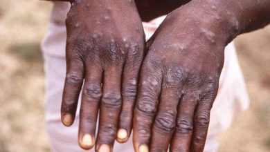 Photo of الصحة العالمية تكشف “أهم أسباب” تفشي جدري القرود