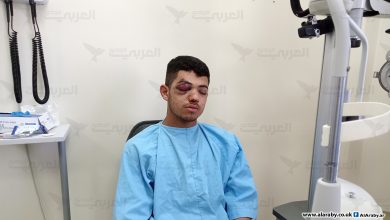 Photo of قنابل الاحتلال تُطفئ عين الفتى الفلسطيني عمر عاصي