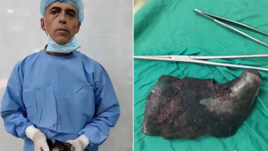 Photo of استخراج شظية بوزن كيلو من كتف مصاب في غزة