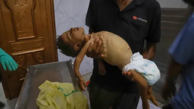 Photo of غزة: وفيات جديدة بسبب سوء التغذية وارتفاع حالات البتر بين الأطفال