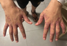 Photo of داء الجرب يجتاح السجون الاسرائيلية واتهامات بتعذيب ممنهج للأسرى