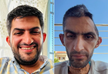 Photo of جمجمته تروي العذاب.. صورة صادمة لمجاهد بني مفلح بعد خروجه من سجون الاحتلال (شاهد)