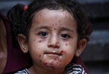 Photo of الصحة في غزة تحذّر من تفشٍ قياسي لجدري الماء: أكثر من 53 ألف إصابة منذ بداية العام