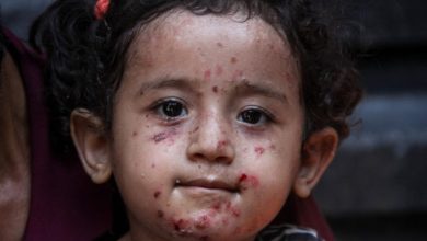 Photo of الصحة في غزة تحذّر من تفشٍ قياسي لجدري الماء: أكثر من 53 ألف إصابة منذ بداية العام